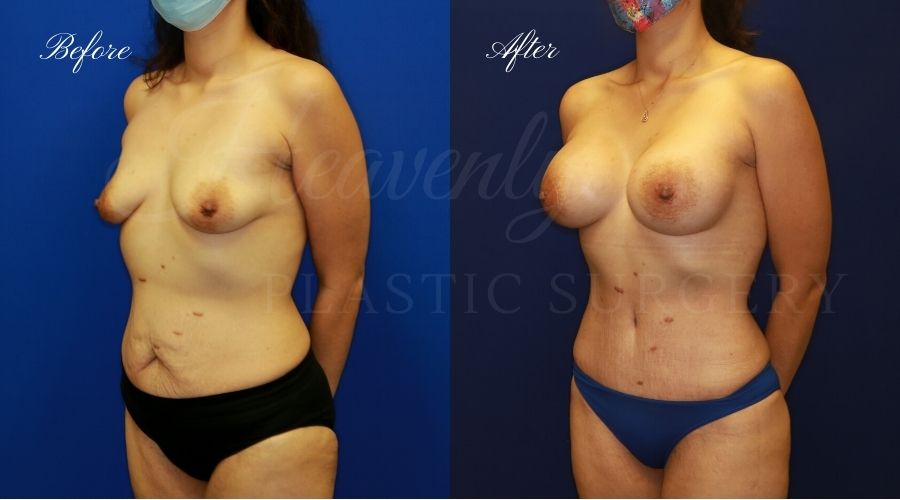 Mommy Makeover - Breast Augmentation, Breast Lift, Tummy Tuck, Liposuction