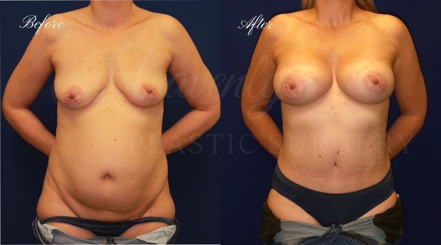 Mommy makeover before and after, breast augmentation before and after, tummy tuck before and after, mommy makeover results, mommy makeover surgeon, breast augmentation surgeon, breast implant surgeon, breast implant surgery, tummy tuck surgeon, abdominoplasty, abdominoplasty surgeon, orange county plastic surgeon, breast implants orange county, tummy tuck orange county, orange county plastic surgeon