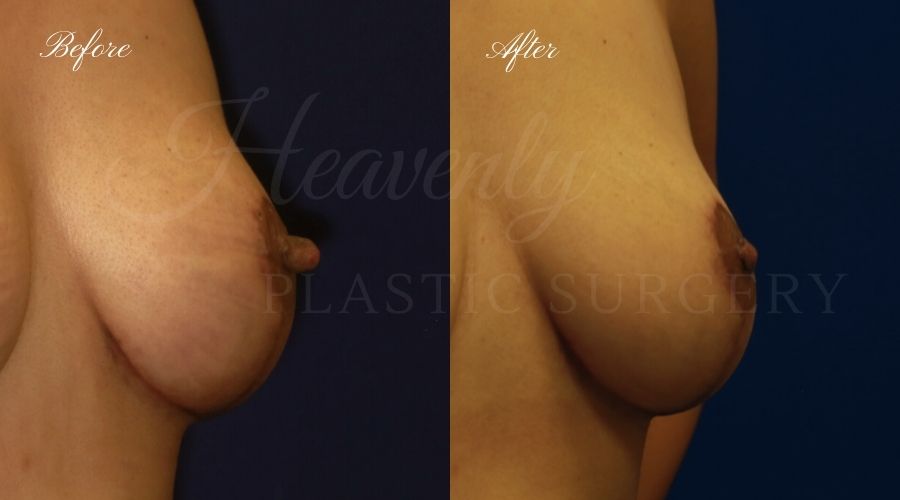 nipple reduction, nipple reduction surgery, nipple reduction surgeon, nipple surgery, plastic surgery, plastic surgeon, nipple reduction orange county, nipple surgery orange county, orange county plastic surgeon, orange county plastic surgery, male nipple reduction