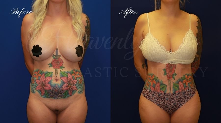 tummy tuck before and after, liposuction before and after, tummy tuck with liposuction, liposuction before and after, tummy tuck orange county, liposuction orange county, lipoetching