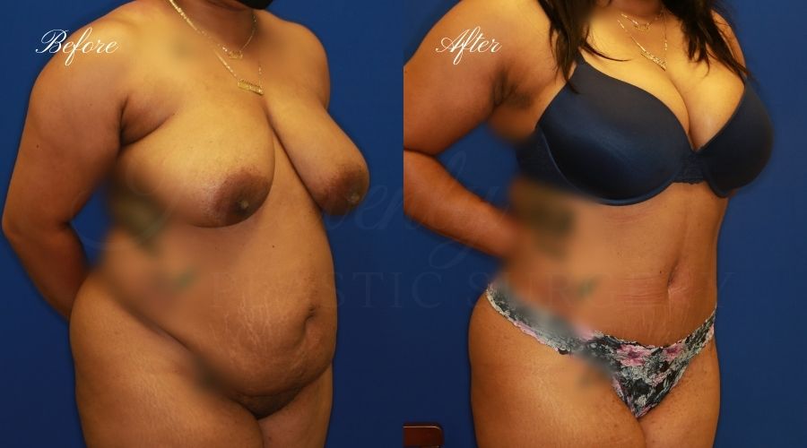 Tummy Tuck Before and After - Right Oblique ASLA Plastic Surgery, Plastic Surgeon, Tummy Tuck, Abdominoplasty, Tummy Tuck with Lipo, Liposuction, Orange County Plastic Surgeon, Orange County Plastic Surgery, Fupa, Fupa surgery, fupa surgeon