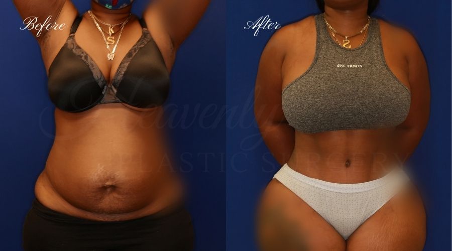 Plastic Surgery, Plastic Surgeon, Tummy Tuck, Abdominoplasty, Tummy Tuck with Lipo, Liposuction, Orange County Plastic Surgeon, Orange County Plastic Surgery, Fupa, Fupa surgeryPlastic Surgery, Plastic Surgeon, Tummy Tuck, Abdominoplasty, Tummy Tuck with Lipo, Liposuction, Orange County Plastic Surgeon, Orange County Plastic Surgery, Fupa, Fupa surgery Plastic Surgery, Plastic Surgeon, Tummy Tuck, Abdominoplasty, Tummy Tuck with Lipo, Liposuction, Orange County Plastic Surgeon, Orange County Plastic Surgery, Fupa, Fupa surgery