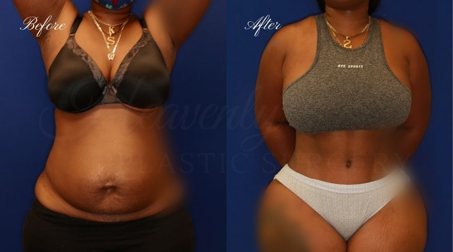 FUPA Surgery, Pubic Area Liposuction