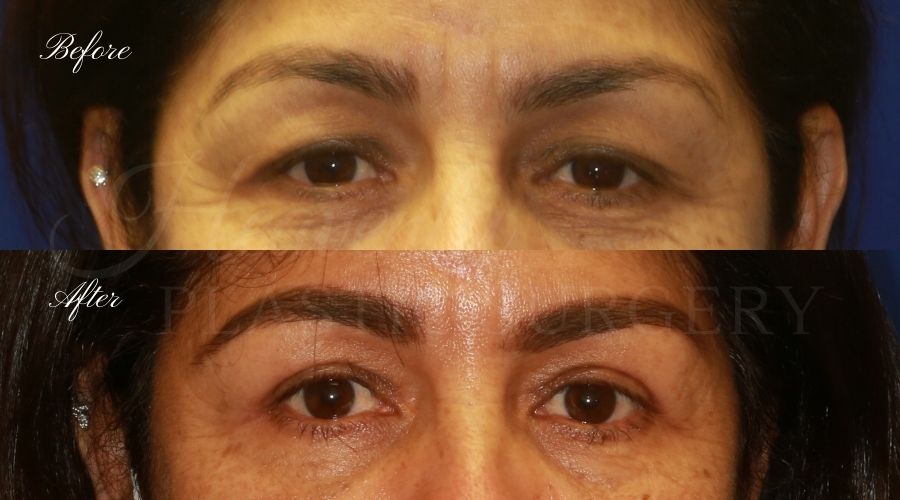 Plastic Surgery, Plastic Surgeon, Eyelid Surgery, Upper blepharoplasty, blepharoplasty, upper eyelids, upper eyelid surgery