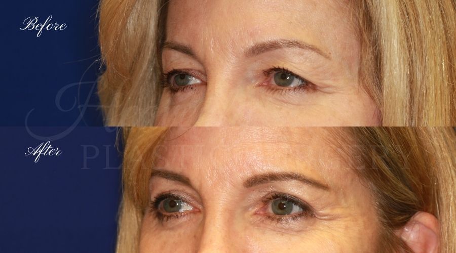 upper eyelid surgery, eyelid surgery, droopy eyelid surgery, upper blepharoplasty before and after, eyelid surgery before and after, eyelid surgery orange county, upper eyelid surgery, blepharoplasty surgeon, upper eyelid surgeon, plastic surgery orange county