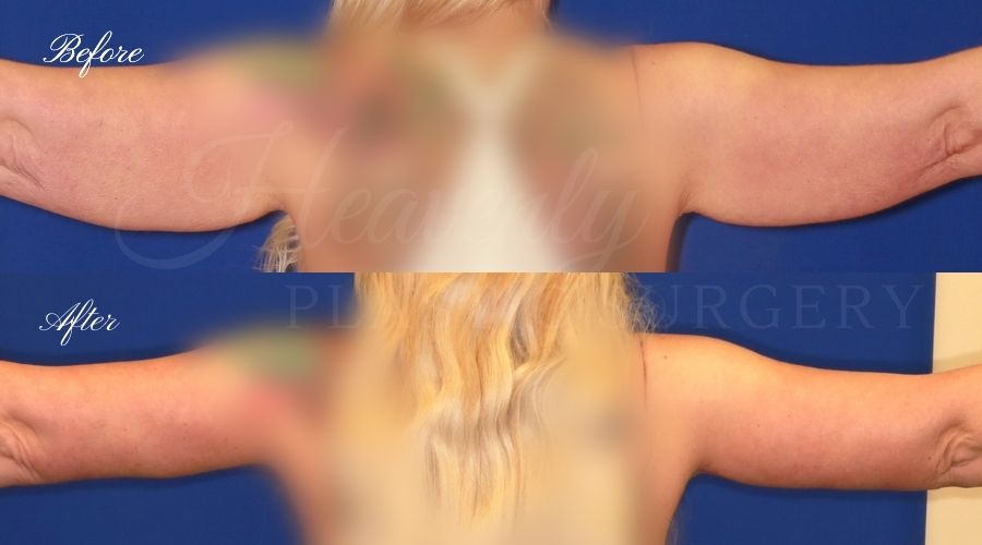 arm lift, arm lift before and after, liposuction before and after, liposuction, liposuction 360, lipo 360, liposuction orange county, arm lift orange county, brachioplasty, brachiplasty before and after, lipoetching, bat wing surgery