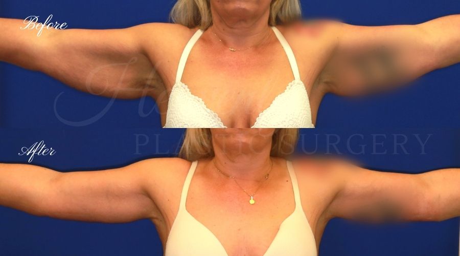 arm lift, arm lift before and after, liposuction before and after, liposuction, liposuction 360, lipo 360, liposuction orange county, arm lift orange county, brachioplasty, brachiplasty before and after, lipoetching, bat wing surgery arm lift, arm lift before and after, liposuction before and after, liposuction, liposuction 360, lipo 360, liposuction orange county, arm lift orange county, brachioplasty, brachiplasty before and after, lipoetching, bat wing surgery