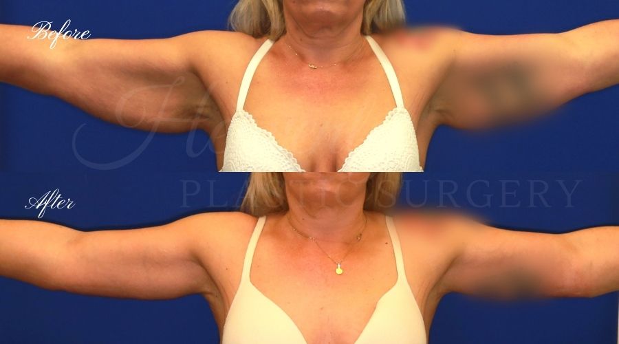 arm lift, arm lift before and after, liposuction before and after, liposuction, liposuction 360, lipo 360, liposuction orange county, arm lift orange county, brachioplasty, brachiplasty before and after, lipoetching, bat wing surgery