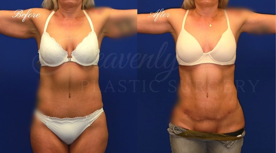 arm lift, arm lift before and after, liposuction before and after, liposuction, liposuction 360, lipo 360, liposuction orange county, arm lift orange county, brachioplasty, brachiplasty before and after, lipoetching, bat wing surgery