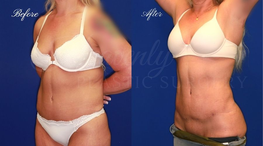 arm lift, arm lift before and after, liposuction before and after, liposuction, liposuction 360, lipo 360, liposuction orange county, arm lift orange county, brachioplasty, brachiplasty before and after, lipoetching, bat wing surgery