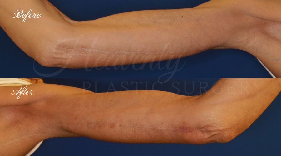 Plastic Surgery, Liposuction, Arm Lift, Brachioplasty, arms, bat wings Plastic Surgery, Liposuction, Arm Lift, Brachioplasty, arms, bat wings