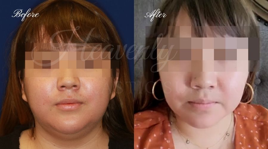 buccal fat pad removal, buccal fat removal, buccal fat pad removal orange county, buccal fat surgeon, buccal fat surgery, cheek fat removal, cheek fat surgery, cheek fat surgeon, cheek surgery before and after, buccal fat pad removal before and after, buccal fat before and after buccal fat pad removal, buccal fat removal, buccal fat pad removal orange county, buccal fat surgeon, buccal fat surgery, cheek fat removal, cheek fat surgery, cheek fat surgeon, cheek surgery before and after, buccal fat pad removal before and after, buccal fat before and after
