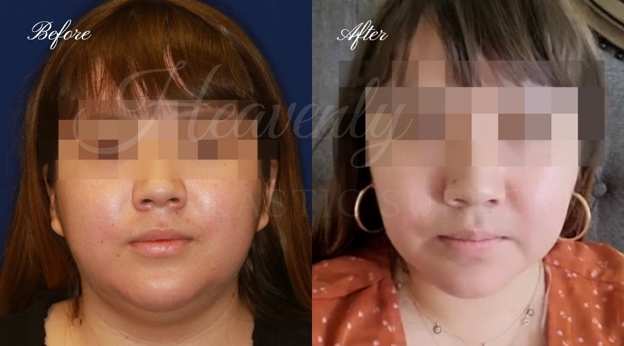 buccal fat pad removal, buccal fat removal, buccal fat pad removal orange county, buccal fat surgeon, buccal fat surgery, cheek fat removal, cheek fat surgery, cheek fat surgeon, cheek surgery before and after, buccal fat pad removal before and after, buccal fat before and after