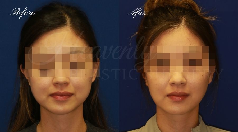 Buccal Fat Pad Removal, Buccal Fat Pad Removal Surgery, Cheekbone surgery, Cheek Plastic Surgery, Cheekbone Plastic Surgery, Cheek Surgery, Cheek Plastic Surgery, Contour