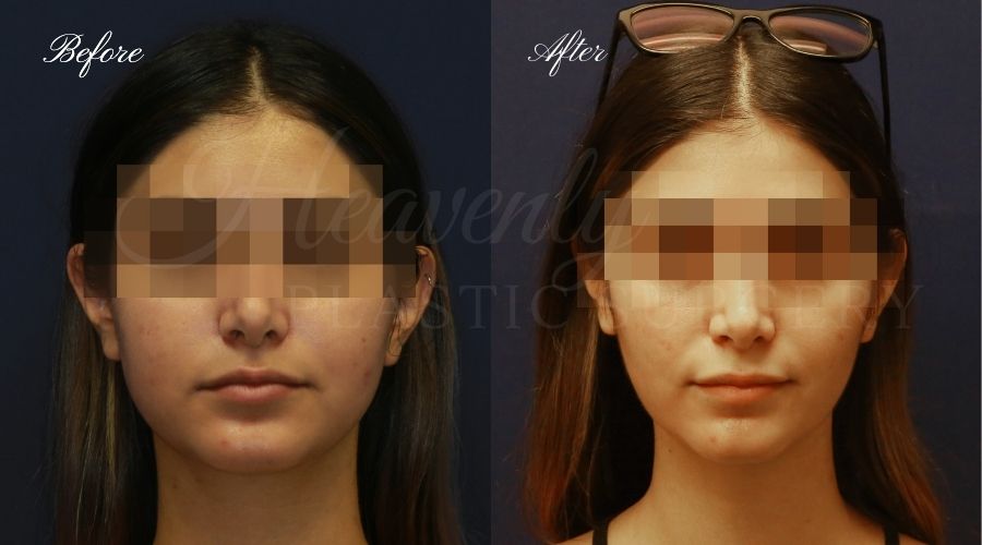 Buccal Fat Pad Removal, Buccal Fat Pad Removal Surgery, Cheekbone surgery, Cheek Plastic Surgery, Cheekbone Plastic Surgery, Cheek Surgery, Cheek Plastic Surgery, Contour Buccal Fat Pad Removal, Buccal Fat Pad Removal Surgery, Cheekbone surgery, Cheek Plastic Surgery, Cheekbone Plastic Surgery, Cheek Surgery, Cheek Plastic Surgery, Contour