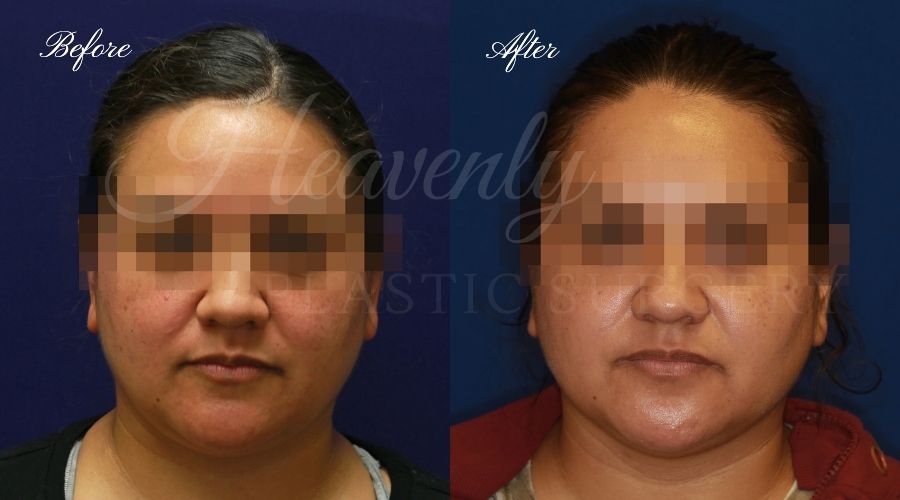 buccal fat pad removal, buccal fat removal, buccal fat pad removal orange county, buccal fat surgeon, buccal fat surgery, cheek fat removal, cheek fat surgery, cheek fat surgeon, cheek surgery before and after, buccal fat pad removal before and after, buccal fat before and after