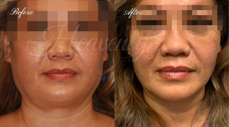 buccal fat pad removal, buccal fat removal, buccal fat pad removal orange county, buccal fat surgeon, buccal fat surgery, cheek fat removal, cheek fat surgery, cheek fat surgeon, cheek surgery before and after, buccal fat pad removal before and after, buccal fat before and after