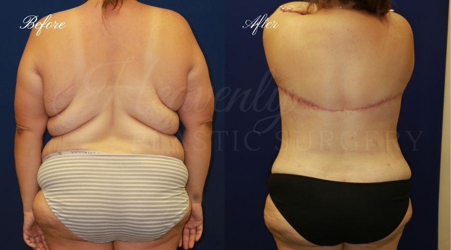 back lift, back lift surgeon, back lift surgery, back lift before and after, plastic surgery before and after, plastic surgery orange county, orange county back lift, back lift surgery orange county, weightloss surgery, weight loss plastic surgery, orange county plastic surgeon