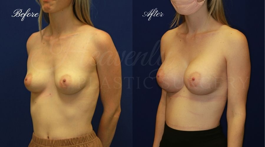 breast augmentation, breast augmentation surgery, breast augmentation surgeon, breast augmentation orange county, breast augmentation with silicone implants, sientra implants, boob job, boob job surgeon, breast implant surgeon, plastic surgery orange county, lake forest plastic surgeon, breast augmentation lake forest, south oc plastic surgeon