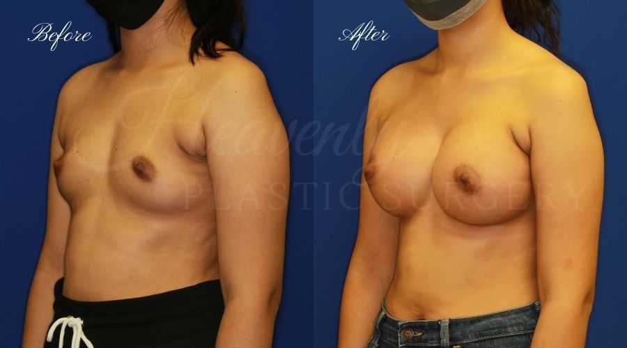 breast augmentation, breast augmentation surgery, breast augmentation surgeon, breast augmentation orange county, breast augmentation with silicone implants, sientra implants, boob job, boob job surgeon, breast implant surgeon, plastic surgery orange county, lake forest plastic surgeon, breast augmentation lake forest, south oc plastic surgeon