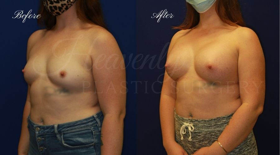 breast augmentation, breast augmentation surgery, breast augmentation surgeon, breast augmentation orange county, breast augmentation with silicone implants, sientra implants, boob job, boob job surgeon, breast implant surgeon, plastic surgery orange county, lake forest plastic surgeon, breast augmentation lake forest, south oc plastic surgeon breast augmentation, breast augmentation surgery, breast augmentation surgeon, breast augmentation orange county, breast augmentation with silicone implants, sientra implants, boob job, boob job surgeon, breast implant surgeon, plastic surgery orange county, lake forest plastic surgeon, breast augmentation lake forest, south oc plastic surgeon