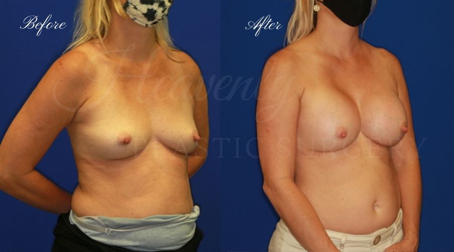 breast augmentation before and after, breast augmentation results, breast augmentation surgery, breast implants before and after, breast implants results, plastic surgery before and after, plastic surgery results, plastic surgeon, breast surgeon, breast augmentation surgeon, breast implant surgeon, breast implants orange county, breast augmentation orange county, orange county plastic surgeon, plastic surgery check