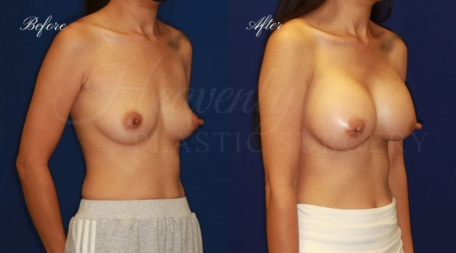 breast augmentation, breast augmentation surgery, breast augmentation surgeon, breast augmentation orange county, breast augmentation with silicone implants, sientra implants, boob job, boob job surgeon, breast implant surgeon, plastic surgery orange county, lake forest plastic surgeon, breast augmentation lake forest, south oc plastic surgeon