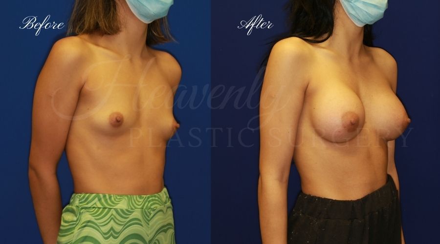 breast augmentation, breast augmentation surgery, breast augmentation surgeon, breast augmentation orange county, breast augmentation with silicone implants, sientra implants, boob job, boob job surgeon, breast implant surgeon, plastic surgery orange county, lake forest plastic surgeon, breast augmentation lake forest, south oc plastic surgeon