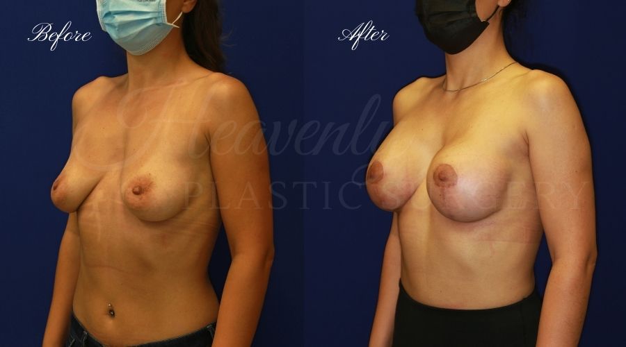 Breast Implants with Lift (Mastopexy-Augmentation - 275cc SRM Silicone under the muscle with Wise-pattern breast lift (anchor scar)