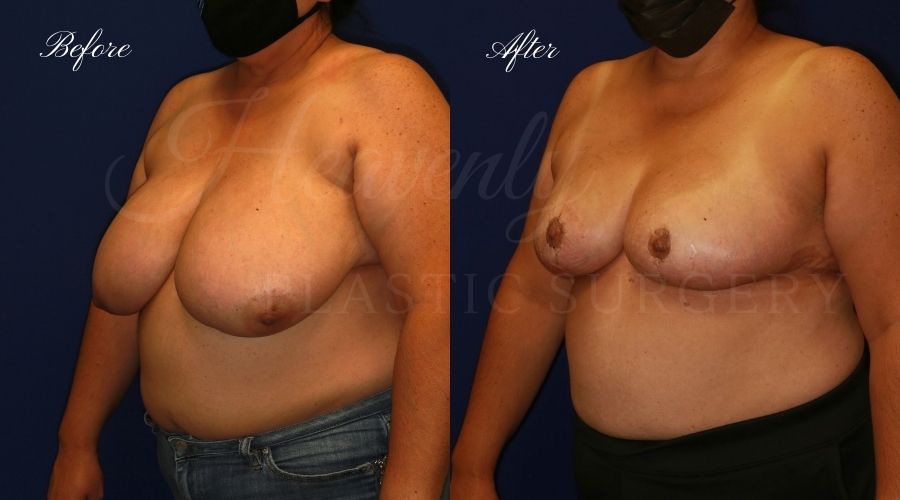 Plastic surgery, plastic surgeon, breast reduction, breast lift, reduction mammaplasty, mastopexy, before and after