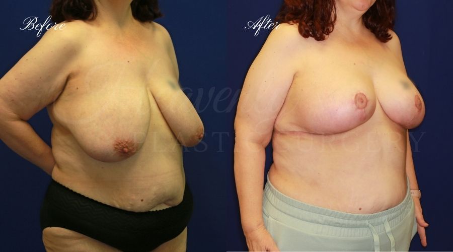 Plastic surgery, plastic surgeon, breast reduction, breast lift, reduction mammaplasty, mastopexy, before and after