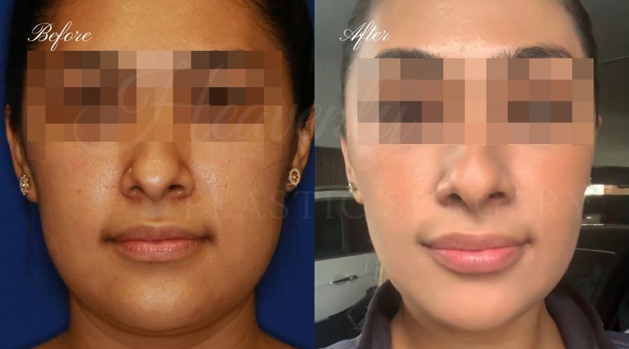 Buccal Fat Pad Removal, Buccal Fat Pad Removal Surgery, Cheekbone surgery, Cheek Plastic Surgery, Cheekbone Plastic Surgery, Cheek Surgery, Cheek Plastic Surgery, Contour Buccal Fat Pad Removal, Buccal Fat Pad Removal Surgery, Cheekbone surgery, Cheek Plastic Surgery, Cheekbone Plastic Surgery, Cheek Surgery, Cheek Plastic Surgery, Contour