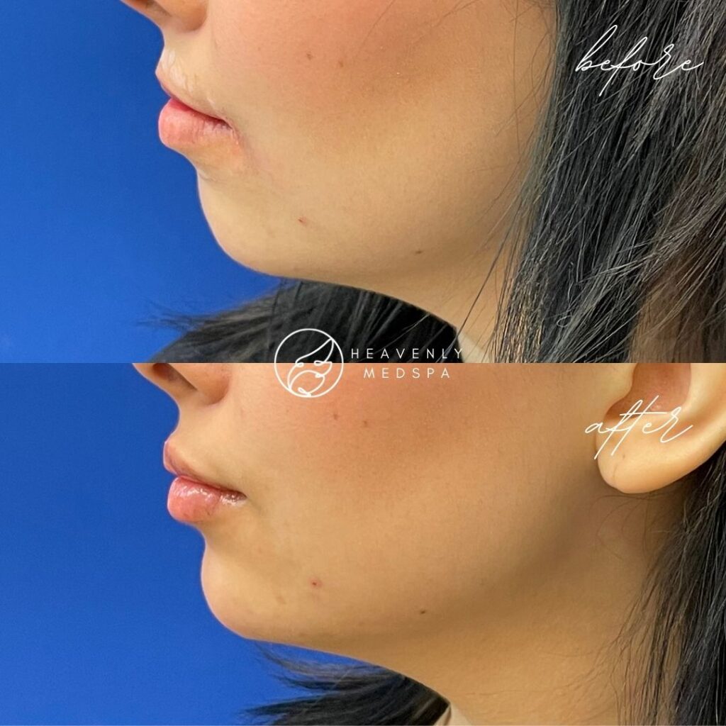 chin filler, chin filler orange county, chin filler nurse injector, nonsurgical chin implant, jawline injection