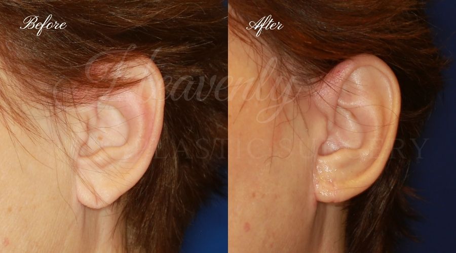Plastic surgery, plastic surgeon, earlobe repair, before and after Plastic surgery, plastic surgeon, earlobe repair, before and after