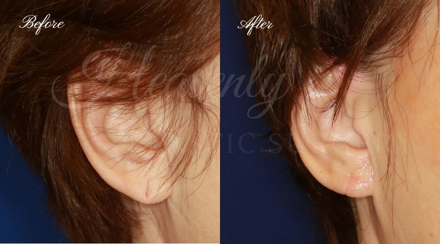 Plastic surgery, plastic surgeon, earlobe repair, before and after Plastic surgery, plastic surgeon, earlobe repair, before and after