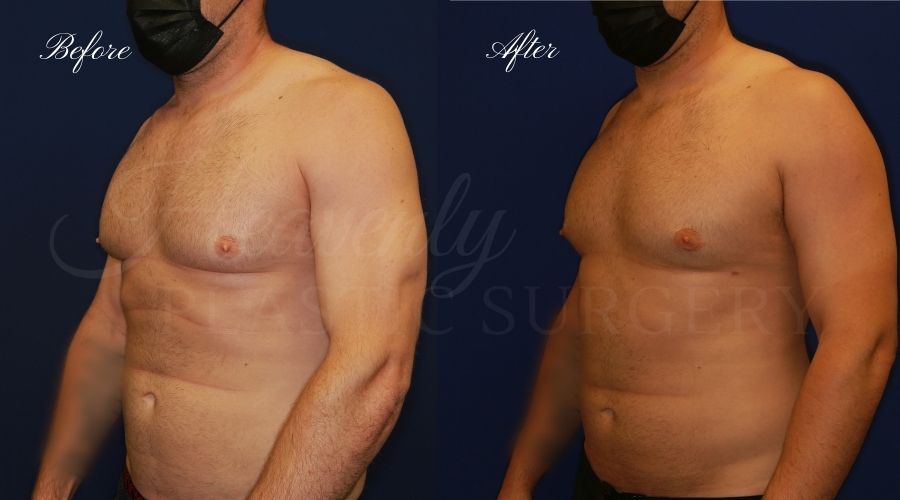 gynecomastia before and after, gynecomastia treatment, gynecomastia results, gynecomastia excision, gynecomastia surgeon, gynecomastia orange county, moobs, man boobs, man boob surgery, male breast tissue, male breast tissue surgery, plastic surgery before and after, plastic surgeon, orange county plastic surgeon, orange county plastic surgery