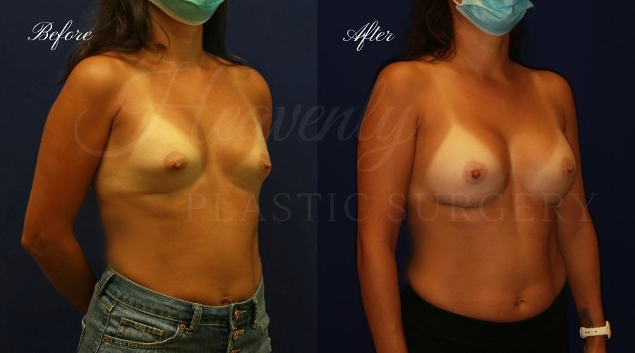 Plastic surgery, plastic surgeon, breast surgery, breast implant revision, deflated breast implant, breast augmentation correction