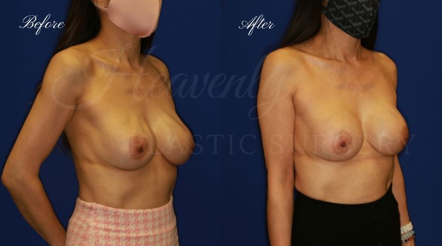 Breast Implant Exchange and Breast Lift - 310cc SRM Silicone Implants with Wise pattern Mastopexy (Anchor Scar)