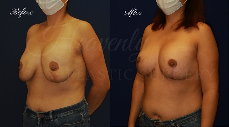 Breast Implant Exchange and Breast Lift - 310cc SRM Silicone Implants with Wise pattern Mastopexy (Anchor Scar)