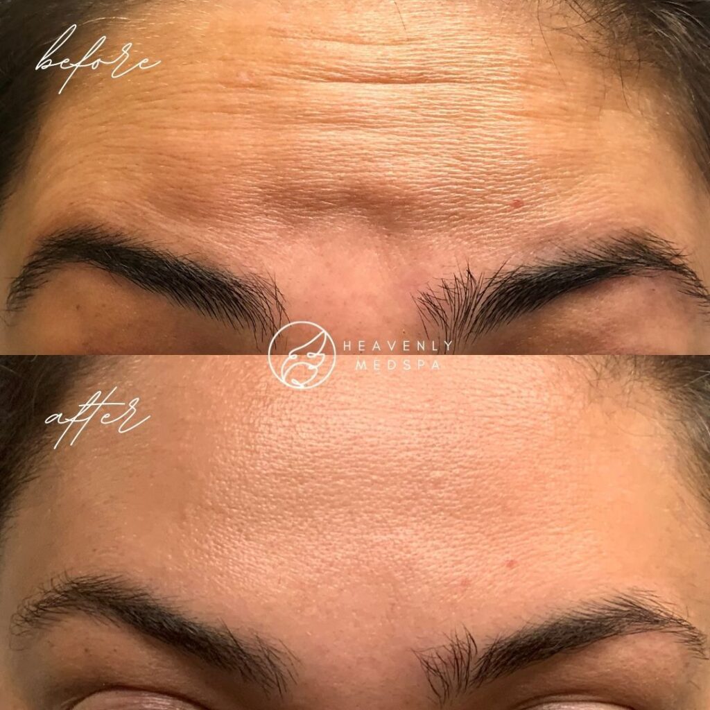 jeuveau, botox, botox orange county, jeuveau orange county, forehead botox, forehead wrinkles, liquid facelift, jeuveau medspa jeuveau, botox, botox orange county, jeuveau orange county, forehead botox, forehead wrinkles, liquid facelift, jeuveau medspa