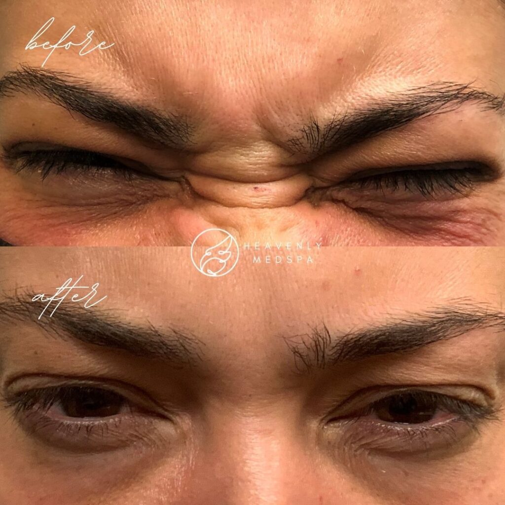 jeuveau, botox, botox orange county, jeuveau orange county, liquid facelift, glabella botox, eyebrow botox, eyebrow wrinkles