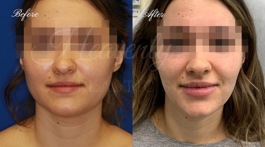 plastic surgery, plastic surgeon, botox, liquid facelift, masseters, masseter botox, jaw botox, masseter muscles plastic surgery, plastic surgeon, botox, liquid facelift, masseters, masseter botox, jaw botox, masseter muscles