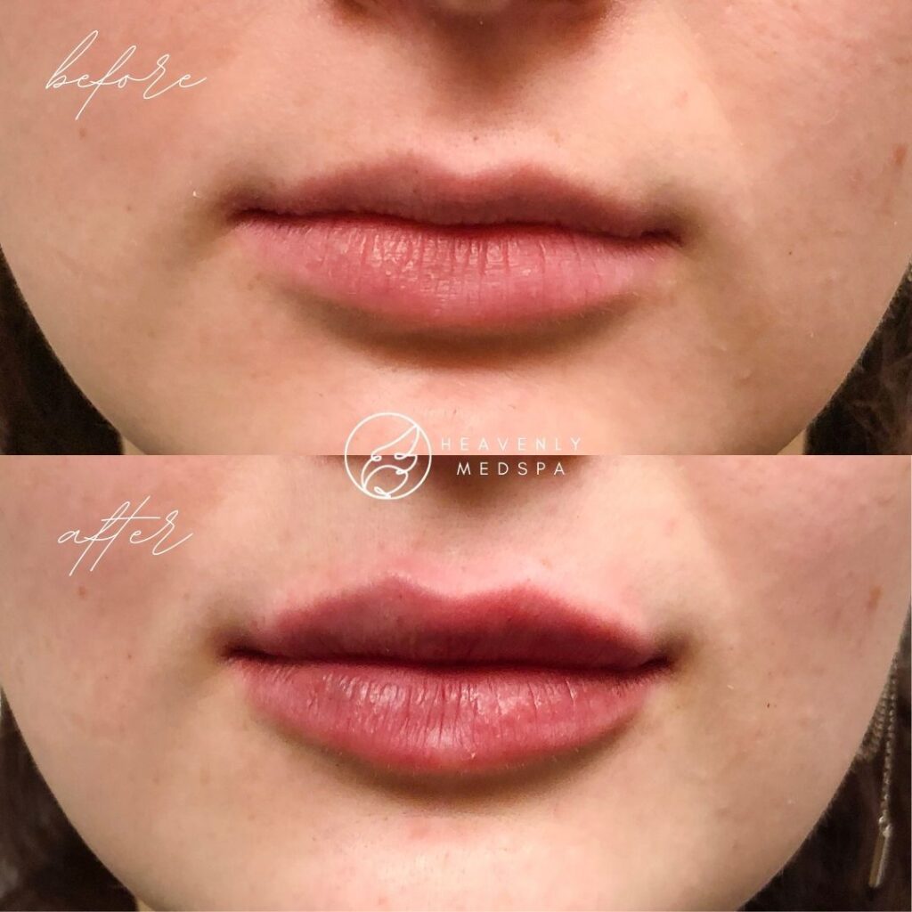 lip filler, dermal filler, lip filler orange county, lip filler foothill ranch, lip filler lake forest, nurse injector, medspa, medspa lake forest, lip filler medspa, lip filler before and after, revanesse versa, versa before and after, lip filler before and after