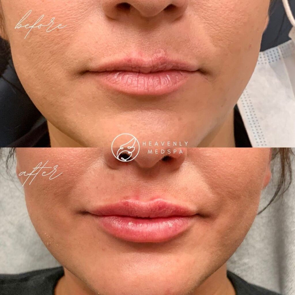 lip filler, dermal filler, lip filler orange county, lip filler foothill ranch, lip filler lake forest, nurse injector, medspa, medspa lake forest, lip filler medspa, lip filler before and after, revanesse versa, versa before and after, lip filler before and after