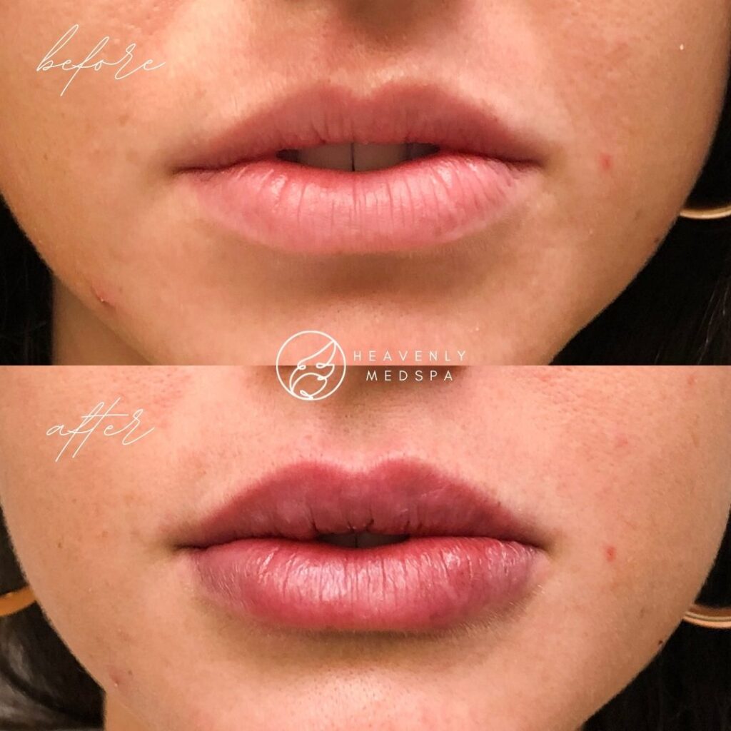 lip filler, dermal filler, lip filler orange county, lip filler foothill ranch, lip filler lake forest, nurse injector, medspa, medspa lake forest, lip filler medspa, lip filler before and after, revanesse versa, versa before and after, lip filler before and after