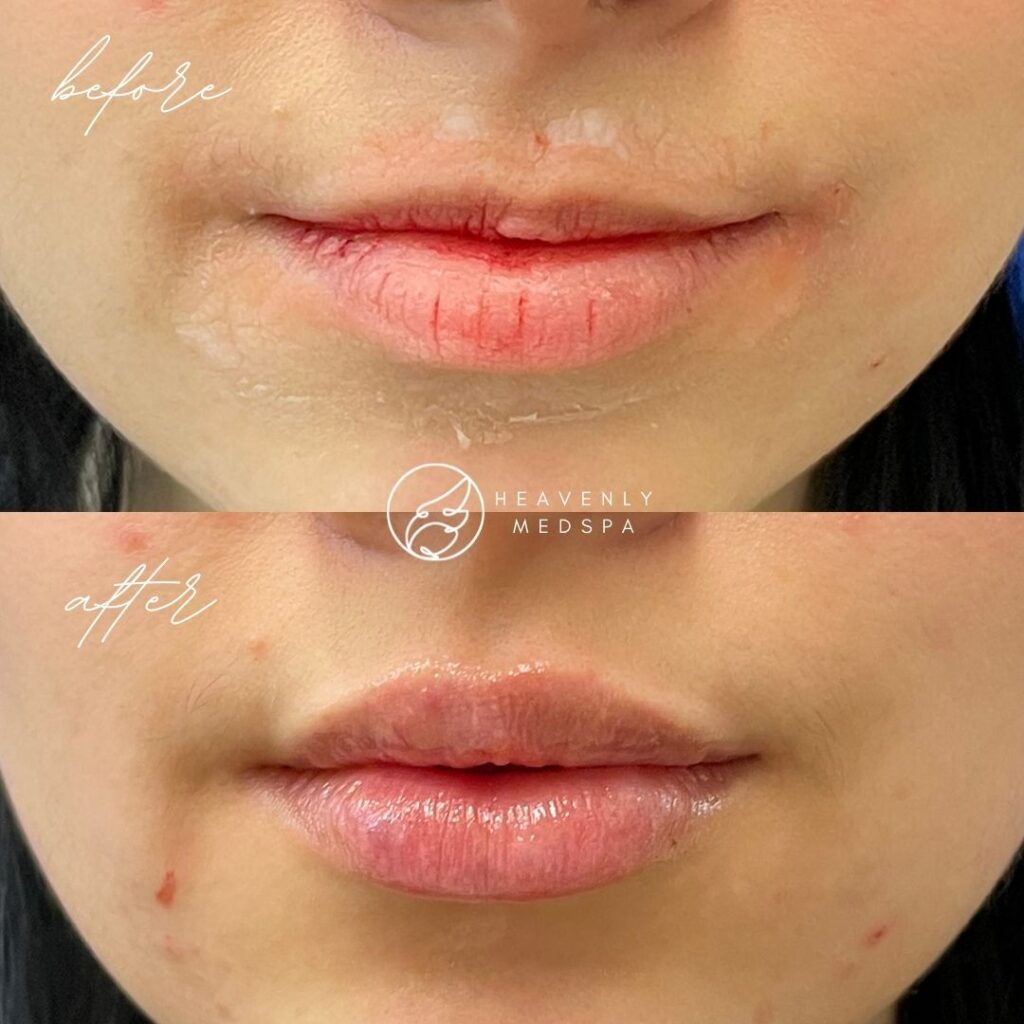 lip filler before and after, filler before and after, lip filler orange county, lip filler lake forest, nurse injector, lip filler medspa, versa, revanesse versa, pout, fuller lips