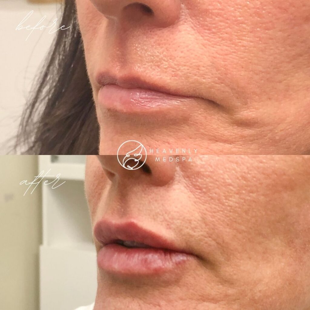 Lip Filler Before and After - Front TISO lip filler, dermal filler, lip filler orange county, lip filler foothill ranch, lip filler lake forest, nurse injector, medspa, medspa lake forest, lip filler medspa, lip filler before and after, revanesse versa, versa before and after, lip filler before and after