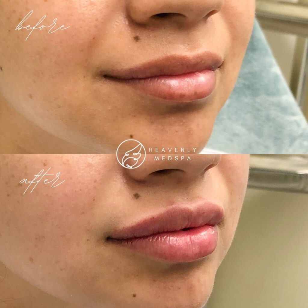 lip filler, dermal filler, lip filler orange county, lip filler foothill ranch, lip filler lake forest, nurse injector, medspa, medspa lake forest, lip filler medspa, lip filler before and after, revanesse versa, versa before and after, lip filler before and after