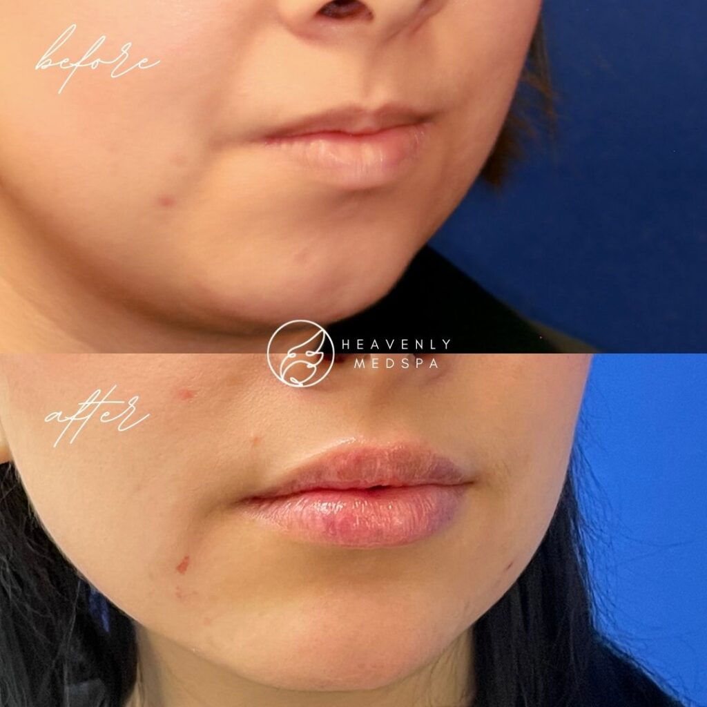 lip filler before and after, filler before and after, lip filler orange county, lip filler lake forest, nurse injector, lip filler medspa, versa, revanesse versa, pout, fuller lips, dermal filler, lip dermal filler