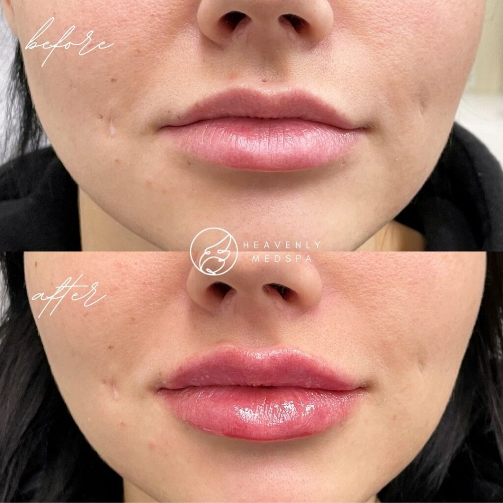 lip filler, dermal filler, lip filler orange county, lip filler foothill ranch, lip filler lake forest, nurse injector, medspa, medspa lake forest, lip filler medspa, lip filler before and after, revanesse versa, versa before and after, lip filler before and after